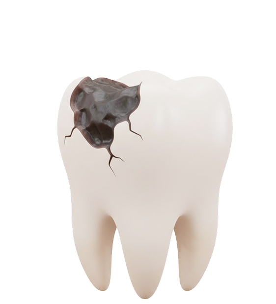 Лечение кариеса <strong>без сверления ICON</strong>