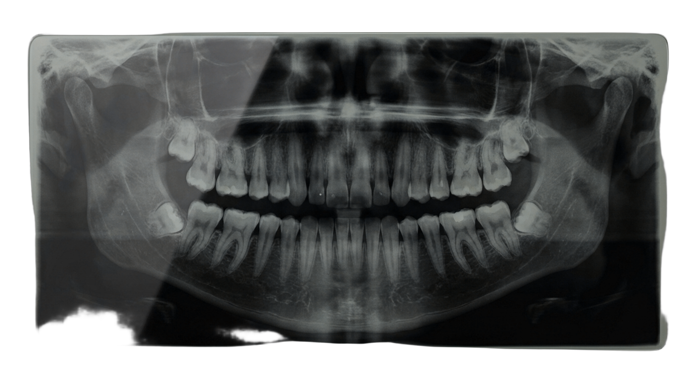 Рентгенография <strong>зубов</strong>