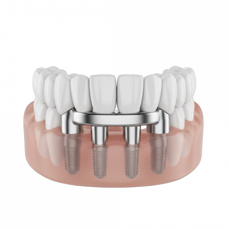 
        Имплантация <strong>All-on-4</strong>