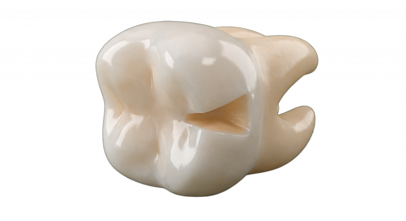 
        Лечение <strong>клиновидного дефекта</strong>