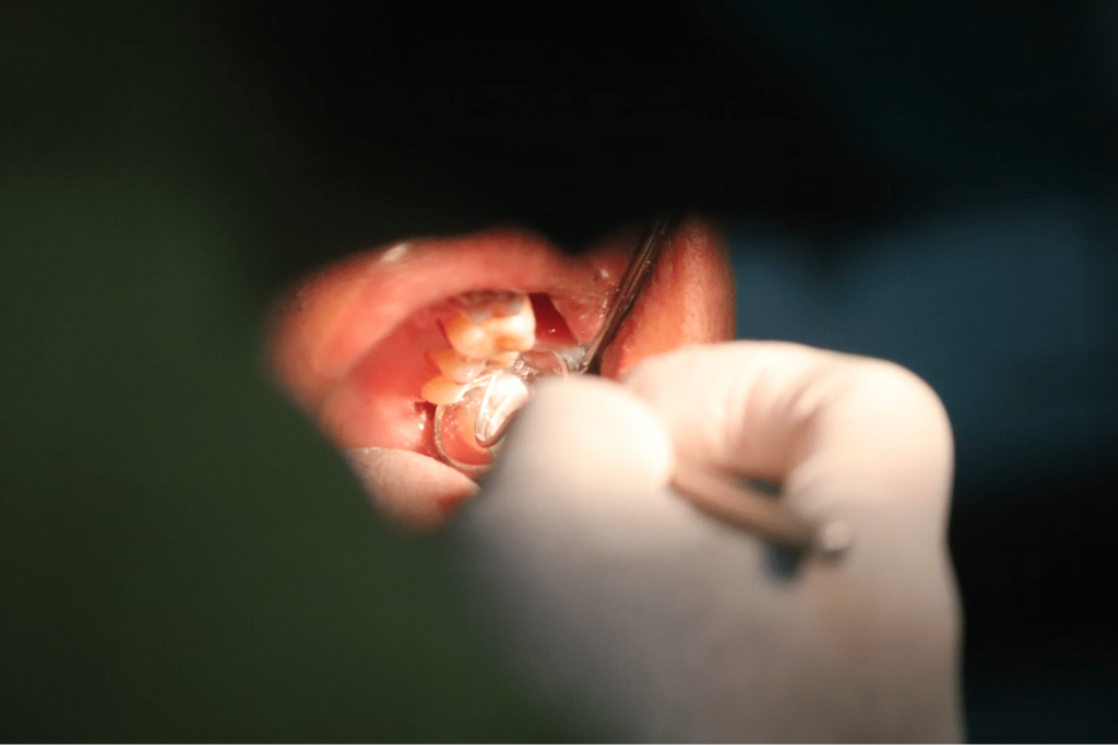 лечение некариозного поражения зубов